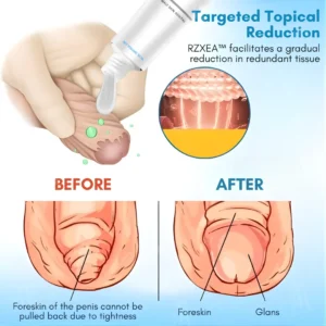 RZXEA™ Foreskin Elasticity Gel 2026 | Non-Surgical Relief