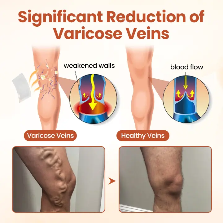 VitaCuroK™ Vein Patch 2026 | Fast Varicose Vein Relief