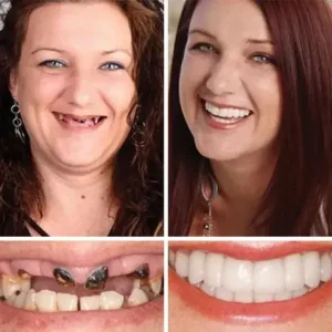 ⏰Ends Today: 70% OFF! 🌎KLENIMORE™ Custom-Fit Dentures— Designed for Comfort and a Natural-Looking Smile