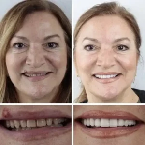 Jakhuors® Premium Denture 2026 | Custom Fit Denture