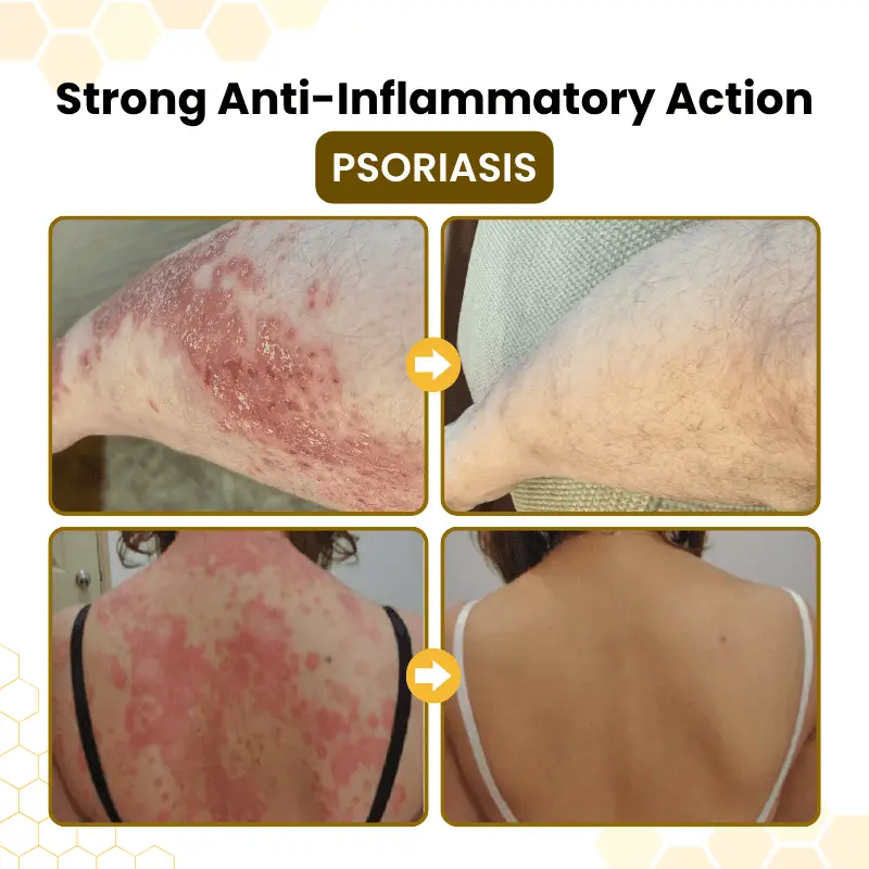 Bellevery® PsoriaSoothe Bee Venom Skin-Restoration Cream