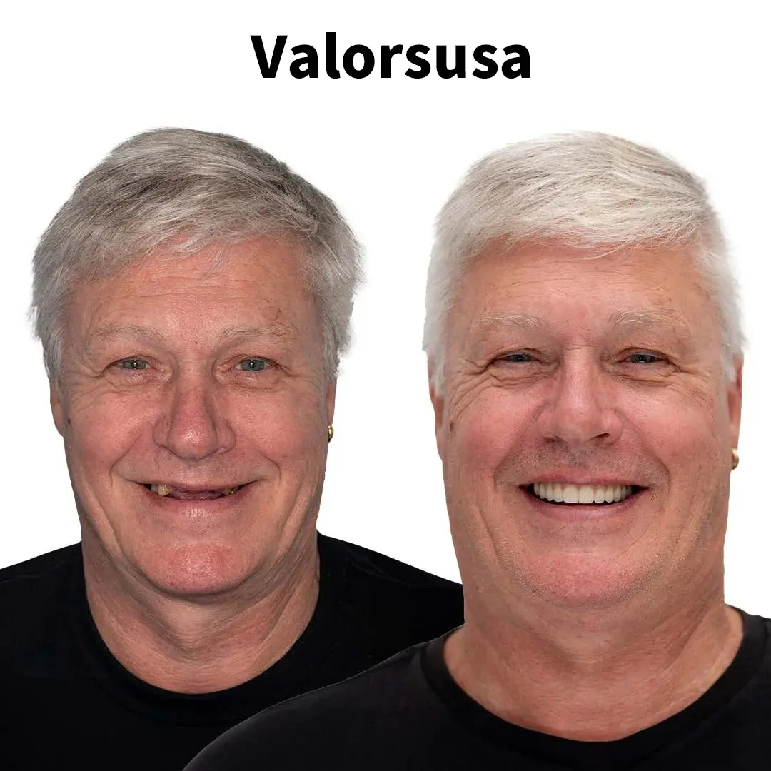 Custom-Fit Instant Smile Dentures – Natural Looking Comfort Fit