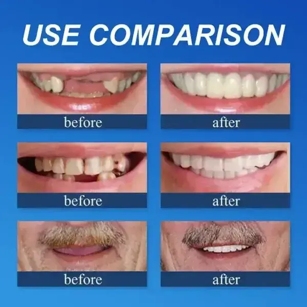 –Ends Today: 75% OFF! ⏰DarkFairy™ Medical Full Denture with Strong Suctiond Custom-Fit Full Functional Dentures🦷