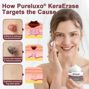 KeraErase Dual-Effect Renewal Cream