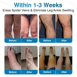 NEYEROS® VeinRepair Microneedle Patch Roll | Spider Vein Care