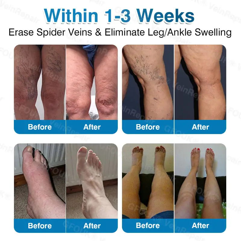 NEYEROS® VeinRepair Microneedle Patch Roll | Spider Vein Care