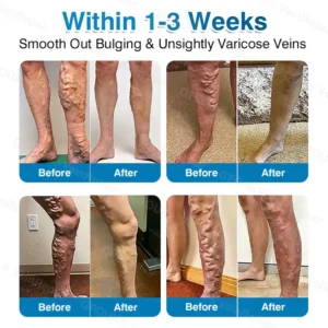 NEYEROS® VeinRepair Microneedle Patch Roll | Spider Vein Care