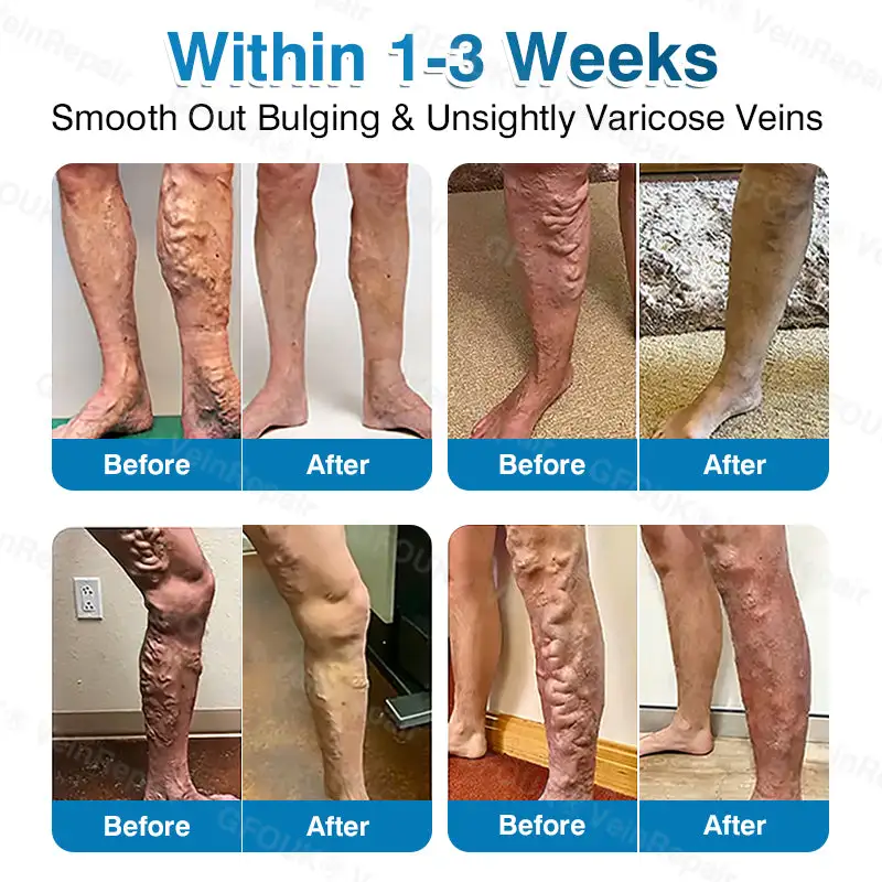 NEYEROS® VeinRepair Microneedle Patch Roll | Spider Vein Care
