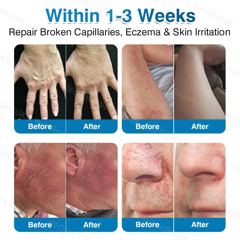 NEYEROS® VeinRepair Microneedle Patch Roll | Spider Vein Care