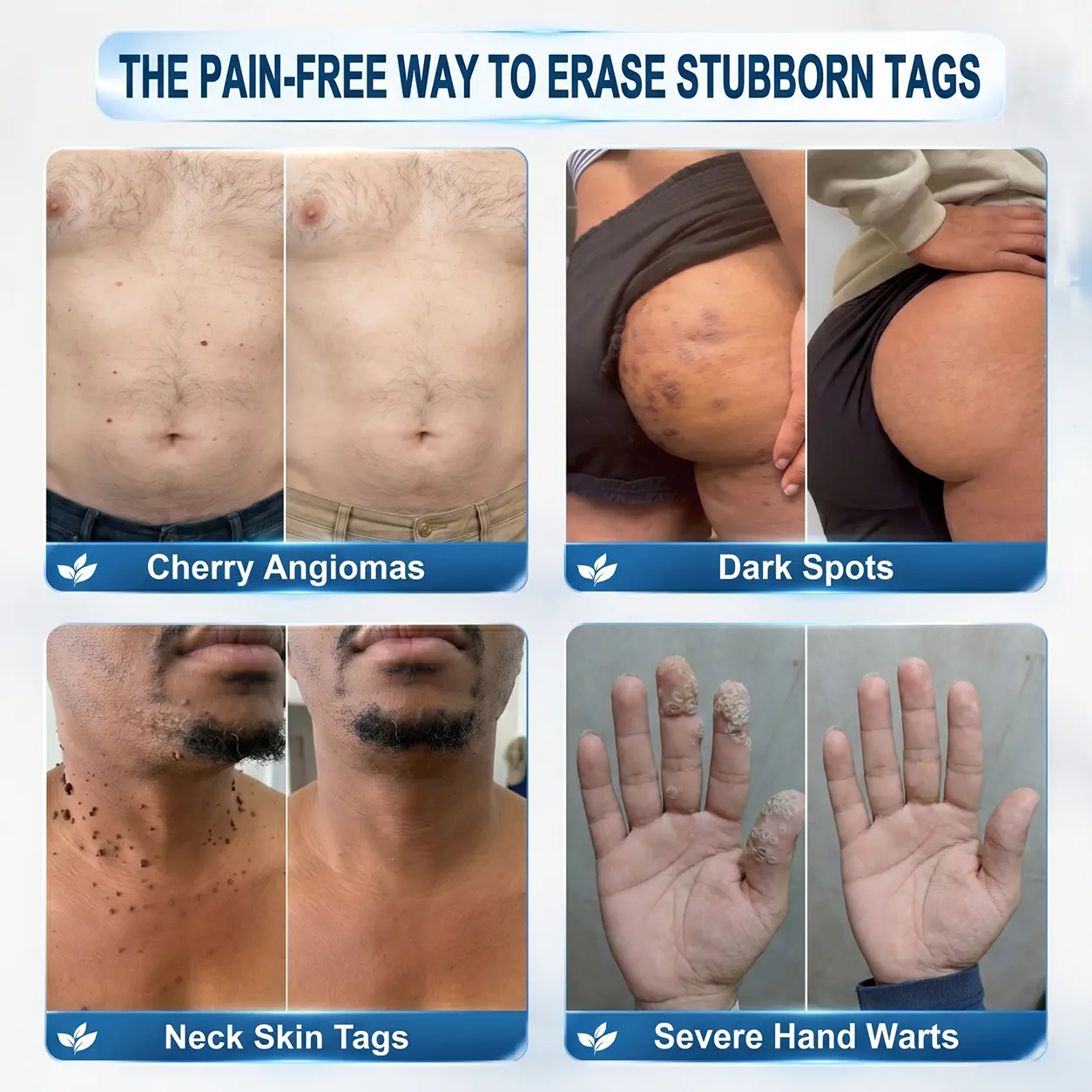 Natravor® 7-Day Skin Tag & Spot Eraser Painless & Scar-Free Advanced Skin Renewal Roller Pen