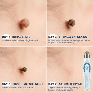 Natravor® 7-Day Skin Tag & Spot Eraser Painless & Scar-Free Advanced Skin Renewal Roller Pen