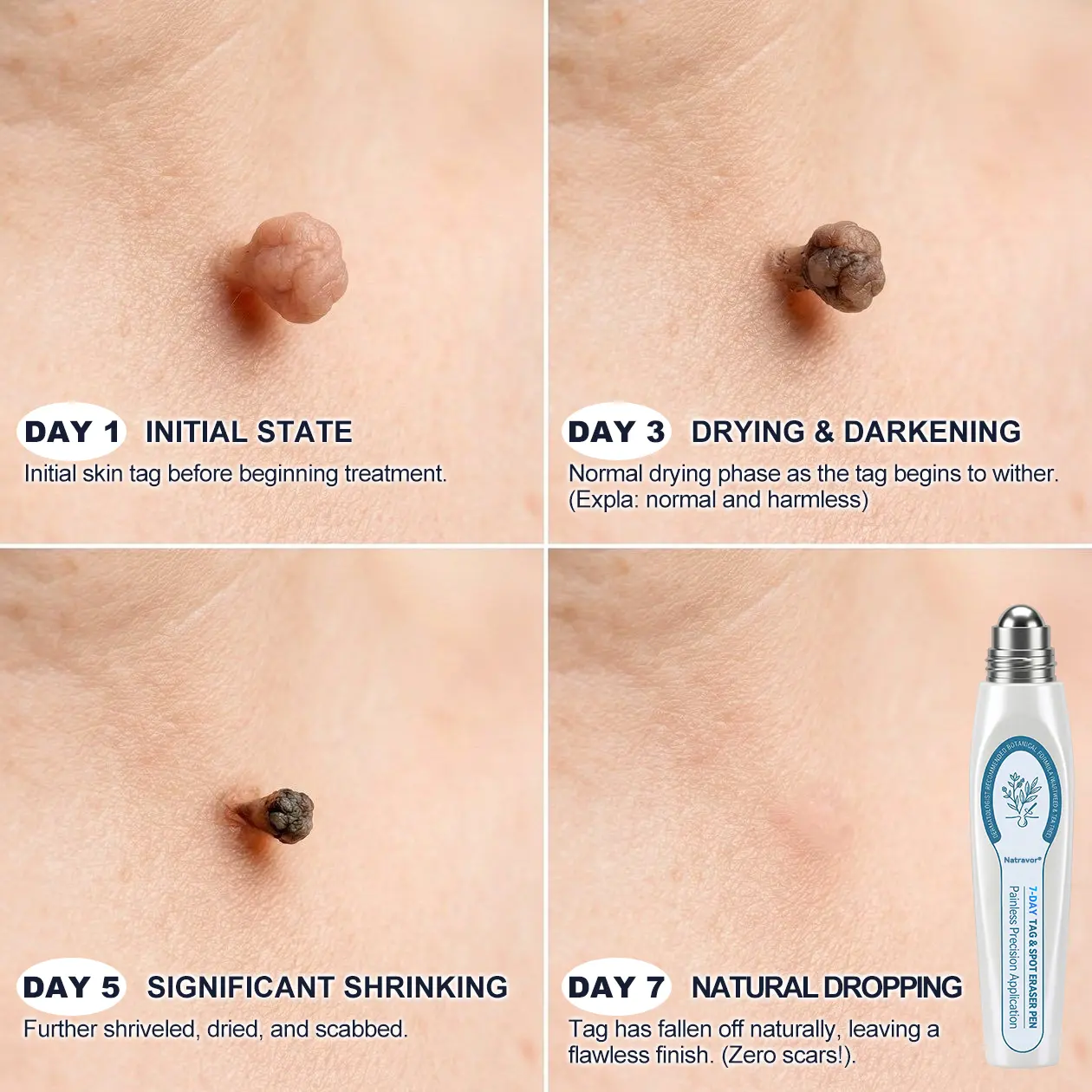 Natravor® 7-Day Skin Tag & Spot Eraser Painless & Scar-Free Advanced Skin Renewal Roller Pen