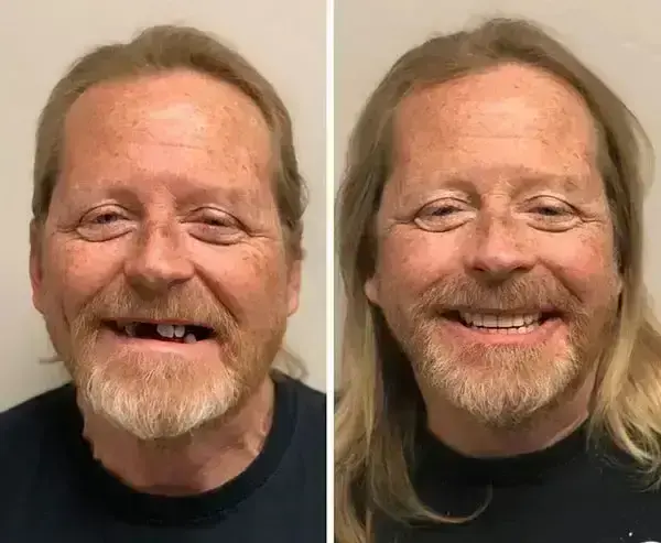 SmileFitPro BioFusion Dentures