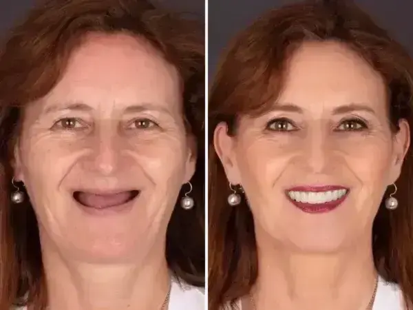 SmileFitPro BioFusion Dentures