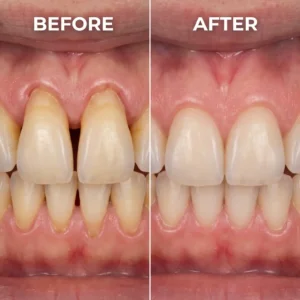 Teeth Repair Gel for Bleeding Gums & Gum Recession | Deep Penetrating Gum Care