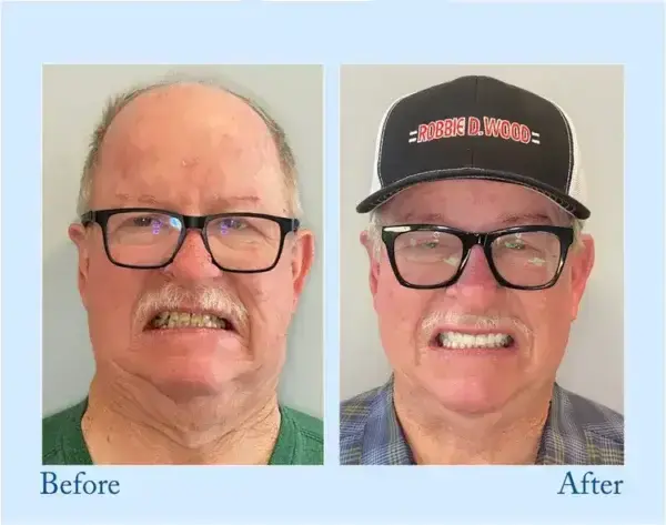TrueEase™ Dentures