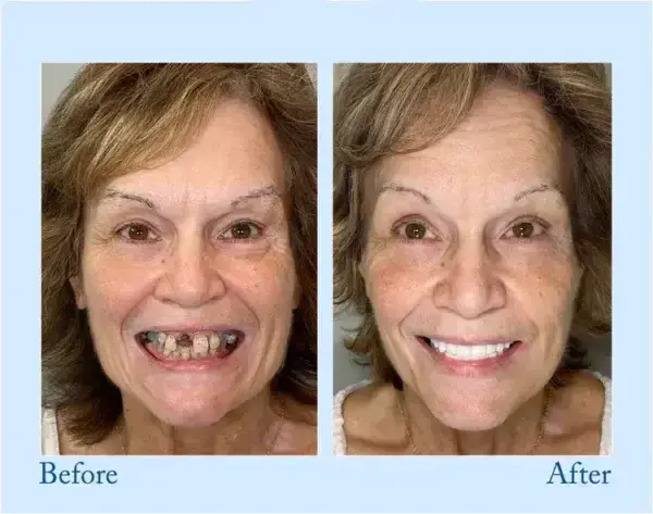 TrueEase™ Dentures