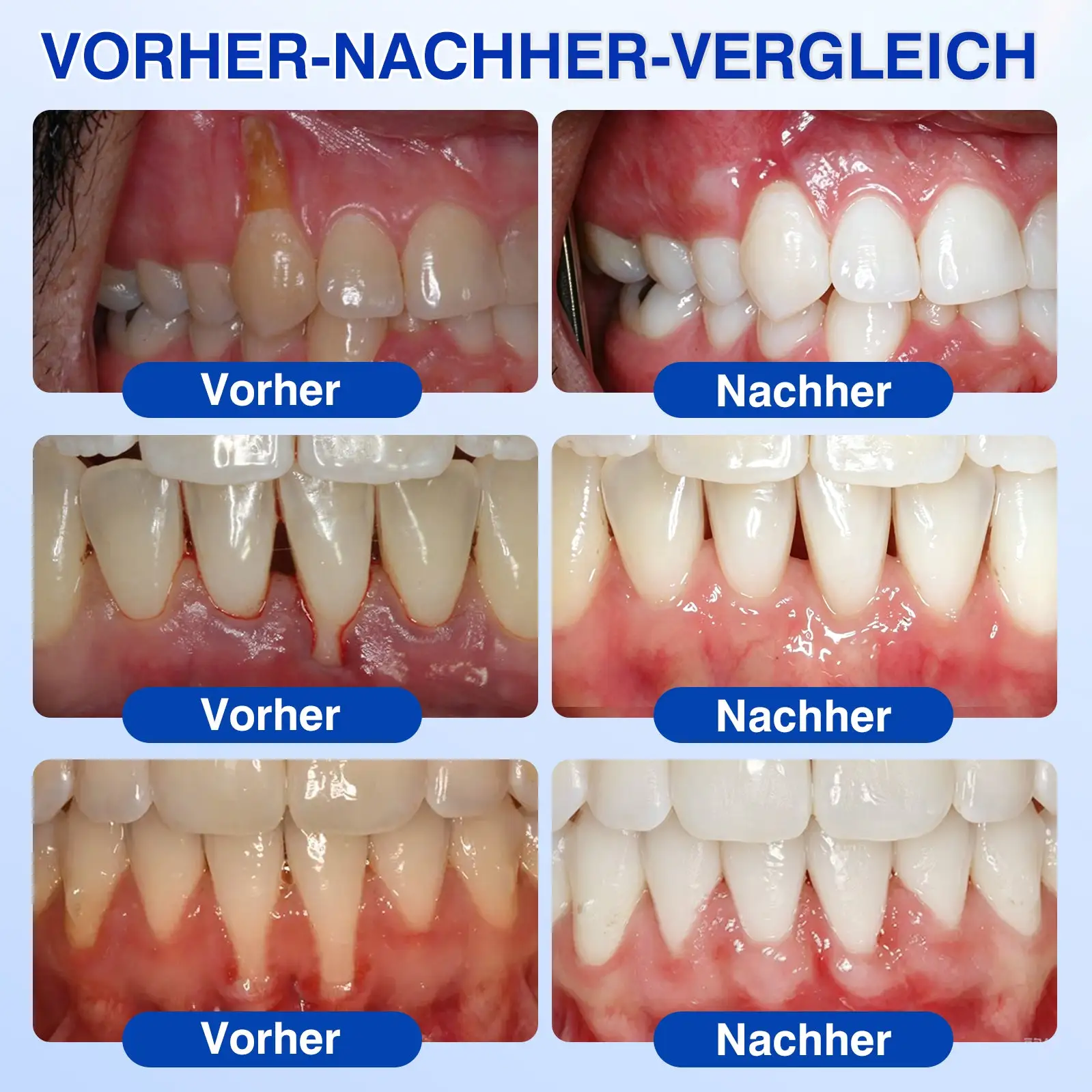 Evolvion® GumRevive Parodontales Reparaturgel