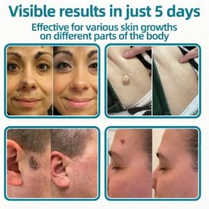 Healrize® 2-in-1 Microneedle & Hydrocolloid Patch