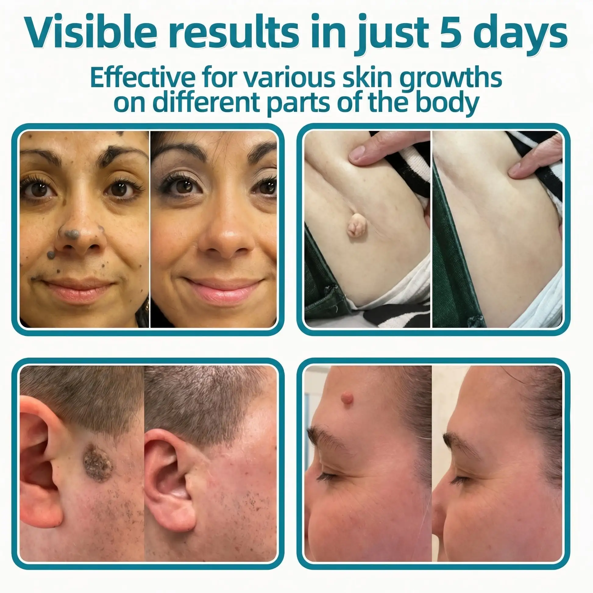 Healrize® 2-in-1 Microneedle & Hydrocolloid Patch