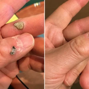 Healrize® 2-in-1 Microneedle & Hydrocolloid Patch