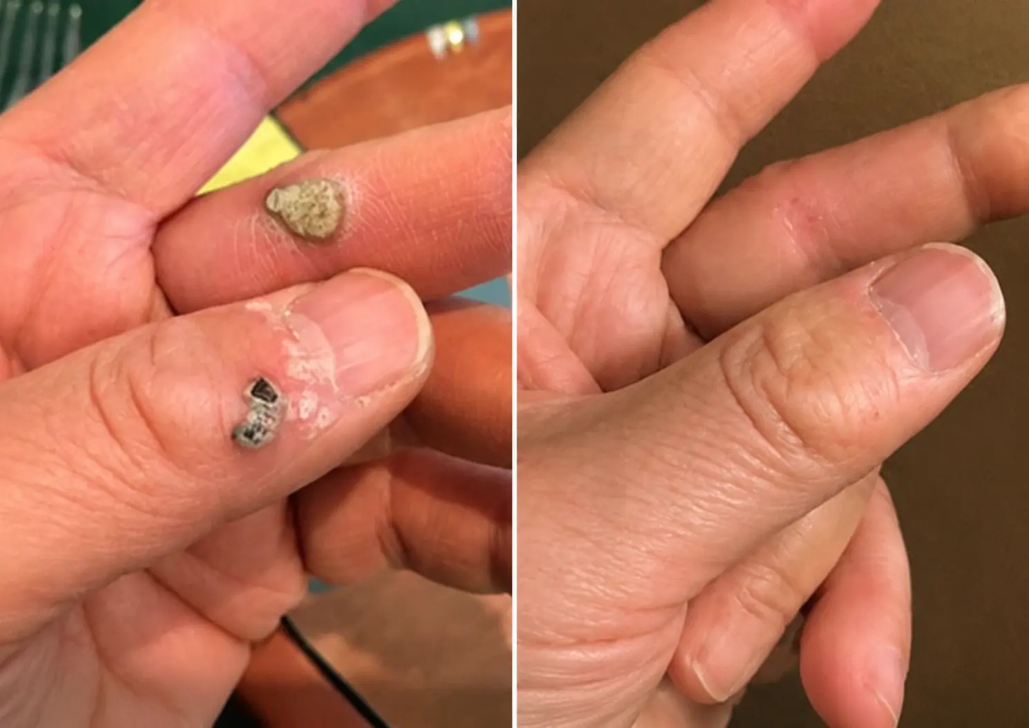 Healrize® 2-in-1 Microneedle & Hydrocolloid Patch